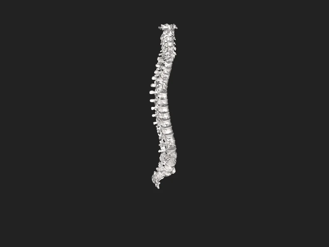 3D model ľudskej chrbtice pri posudzovaní nároku na invalidný dôchodok